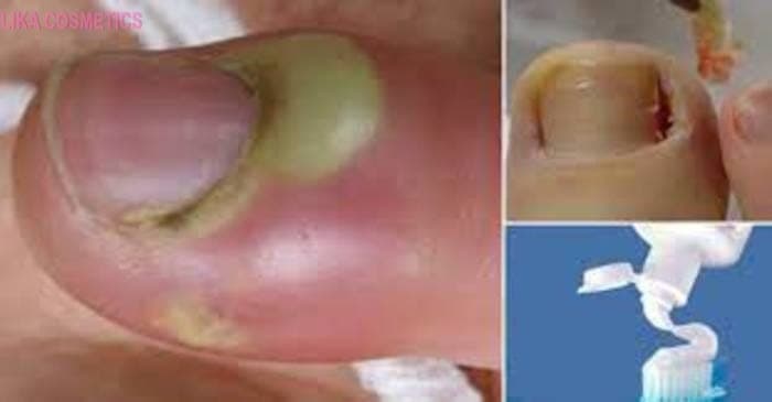 Chín mé và những điều cần biết về cách chữa chín mé bằng kem đánh răng