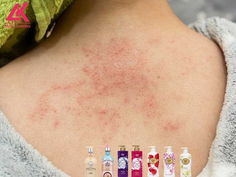 8 loại sữa tắm trị viêm nang lông của Hàn Quốc