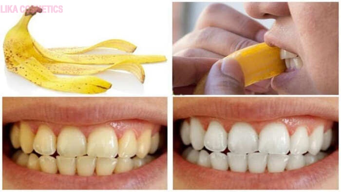 Cách làm trắng răng bị vàng bằng chuối