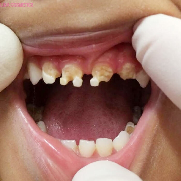 Trẻ bị mòn răng do vi khuẩn và axit trong thức ăn