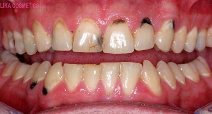 Răng bị mảng bám đen phải làm sao